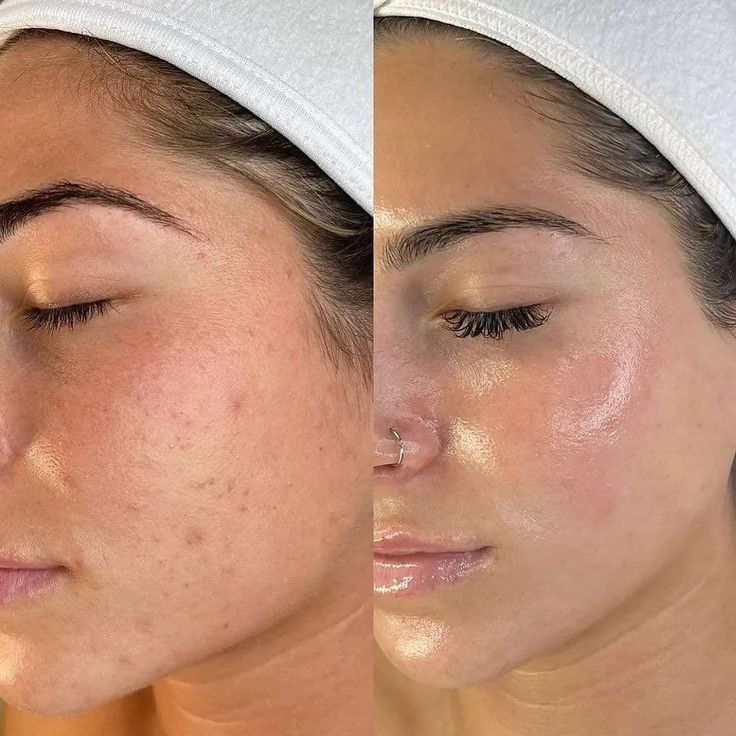 Acne Clean Up