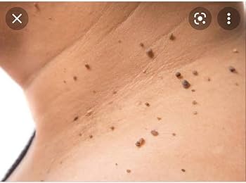 wart,s remover